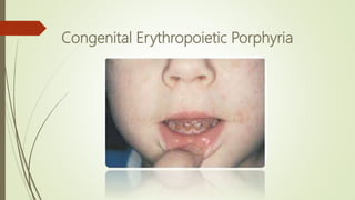 Congenital Erythropoietic Porphyria
 