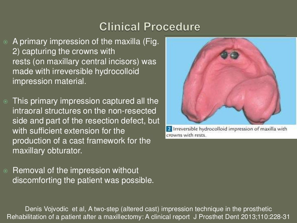 Altered Cast Impression Technique for Fabrication of Maxillary Obtura…
