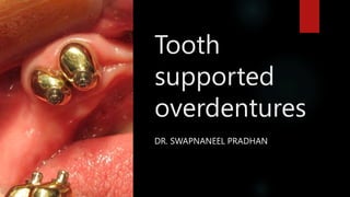 Tooth
supported
overdentures
DR. SWAPNANEEL PRADHAN
 