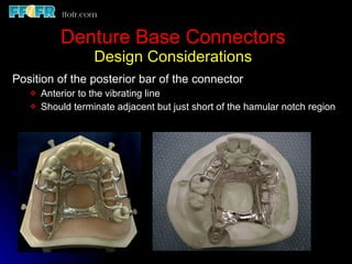 Tooth Connection Engineering Tooth tissue junction, major and minor connectors | PPT