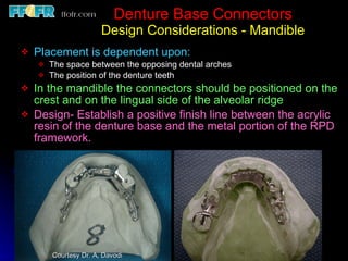 Metal Rpd Finish Line Tooth tissue junction, major and minor connectors | PPT