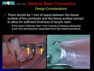 Tooth Connection Engineering Tooth tissue junction, major and minor connectors | PPT