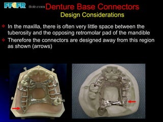 Tooth Connection Engineering Tooth tissue junction, major and minor connectors | PPT