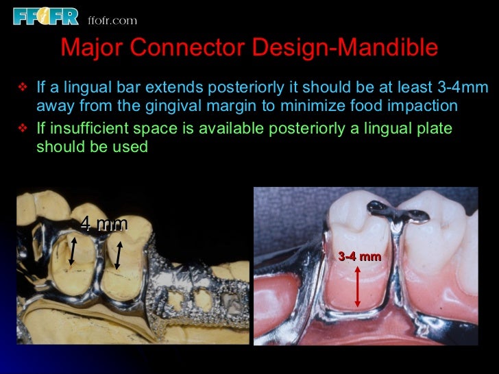 Tooth tissue junction, major and minor connectors