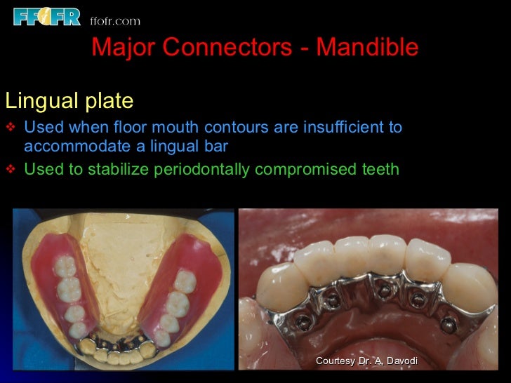 Tooth tissue junction, major and minor connectors