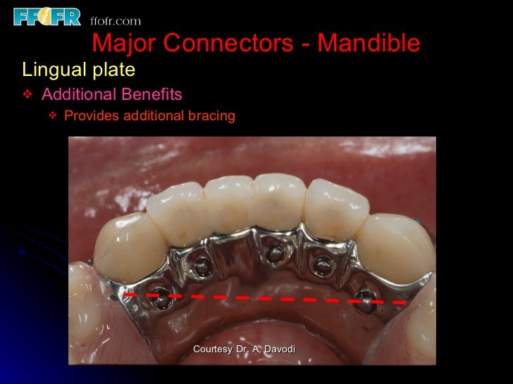 Tooth tissue junction, major and minor connectors