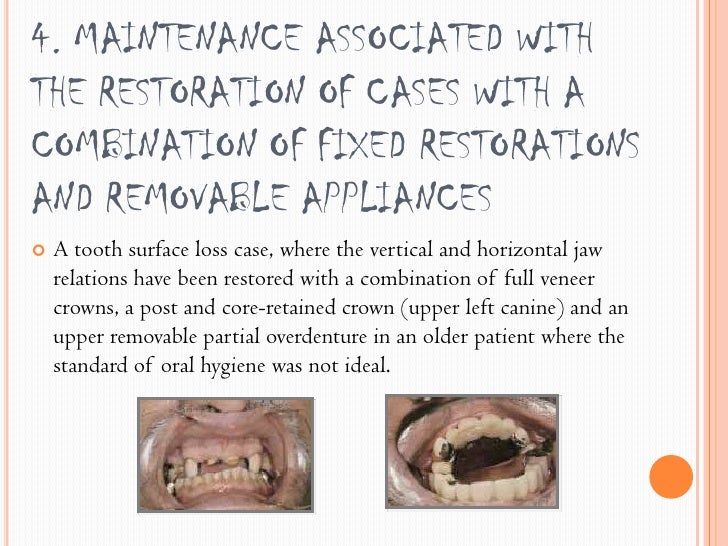 Tooth wear and its types