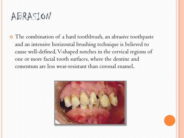 Tooth wear and its types