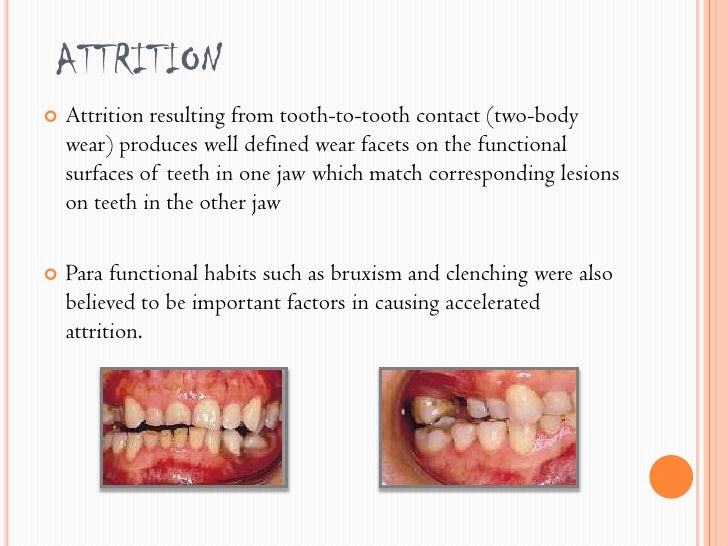Tooth wear and its types