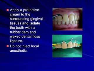 Apply a protective
cream to the
surrounding gingival
tissues and isolate
the tooth with a
rubber dam and
waxed dental floss
ligature.
Do not inject local
anesthetic.

 