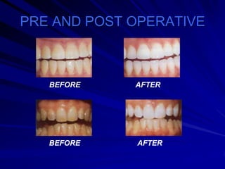 PRE AND POST OPERATIVE

BEFORE

AFTER

BEFORE

AFTER

 
