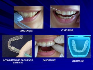 FLOSSING

BRUSHING

APPLICATION OF BLEACHING
MATERIAL

INSERTION

STORAGE

 