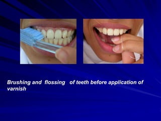 Brushing and flossing of teeth before application of
varnish

 