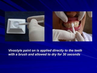Vivastyle paint on is applied directly to the teeth
with a brush and allowed to dry for 30 seconds

 