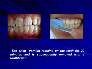 The dried varnish remains on the teeth for 20
minutes and is subsequently removed with a
toothbrush.

 