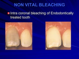 NON VITAL BLEACHING
Intra coronal bleaching of Endodontically
treated tooth

 
