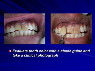 Evaluate tooth color with a shade guide and
take a clinical photograph

 