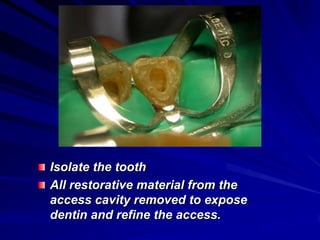 Isolate the tooth
All restorative material from the
access cavity removed to expose
dentin and refine the access.

 