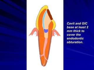 Cavit and GIC
base at least 2
mm thick to
cover the
endodontic
obturation.

 