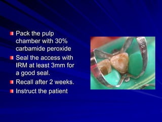 Pack the pulp
chamber with 30%
carbamide peroxide
Seal the access with
IRM at least 3mm for
a good seal.
Recall after 2 weeks.
Instruct the patient

 