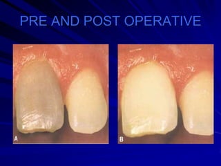 PRE AND POST OPERATIVE

 
