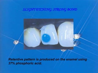 SLIGHT ETCHING; STRONG BOND

Retentive pattern is produced on the enamel using
37% phosphoric acid.

 