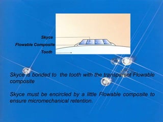 Skyce

Flowable Composite
Tooth

Skyce is bonded to the tooth with the transparent Flowable
composite
Skyce must be encircled by a little Flowable composite to
ensure micromechanical retention.

 