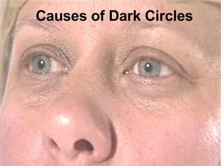 Causes of Dark Circles 