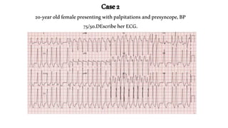 Top100 ECG cases anilkumarhhhhhhhhhhbvfv.pdf