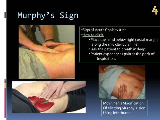 top 10 signs in gastroenterology murphy s sign