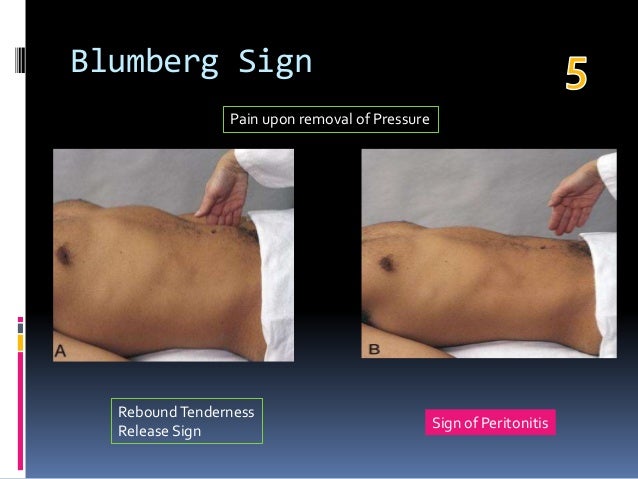 Appendix Murphy Sign Top 10 signs in gastroenterology