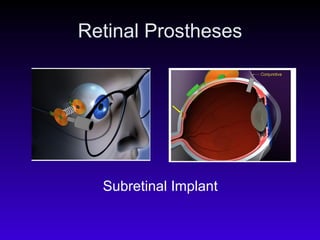Retinal Prostheses Subretinal Implant 