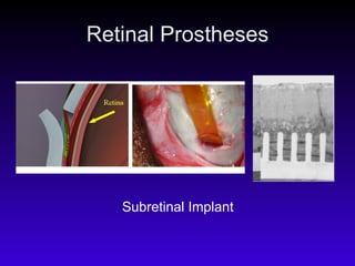 Retinal Prostheses Subretinal Implant 
