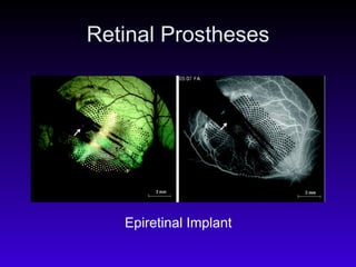 Retinal Prostheses Epiretinal Implant 
