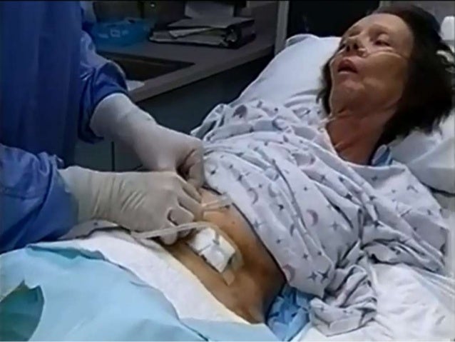 percutaneous endoscopic gastrostomy peg The ins & outs of gastrostomy tubes feasibiity of the cut-and-push method for removing large-caliber soft percutaneous endoscopic gastrostomy devices. percutaneous endoscopic gastrostomy peg The ins & outs of gastrostomy tubes feasibiity of the cut-and-push method for removing large-caliber soft percutaneous endoscopic gastrostomy devices.