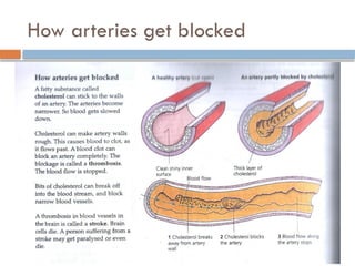 How arteries get blocked
 