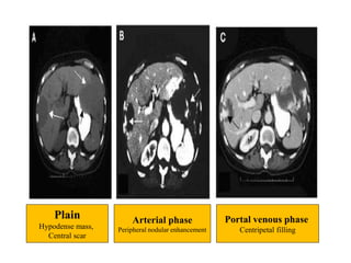 Plain
Hypodense mass,
Central scar
Arterial phase
Peripheral nodular enhancement
Portal venous phase
Centripetal filling
 