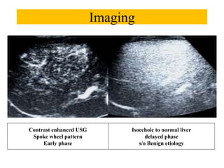 Imaging
Contrast enhanced USG
Spoke wheel pattern
Early phase
Isoechoic to normal liver
delayed phase
s/o Benign etiology
 