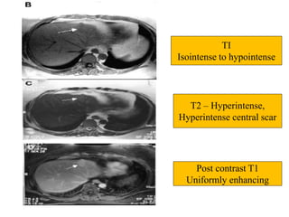 TI
Isointense to hypointense
T2 – Hyperintense,
Hyperintense central scar
Post contrast T1
Uniformly enhancing
 