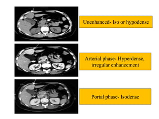 Unenhanced- Iso or hypodense
Arterial phase- Hyperdense,
irregular enhancement
Portal phase- Isodense
 
