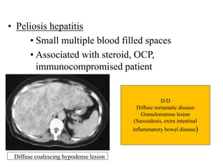 • Peliosis hepatitis
• Small multiple blood filled spaces
• Associated with steroid, OCP,
immunocompromised patient
D/D
Diffuse metastatic disease
Granulomatous lesion
(Sarcoidosis, extra intestinal
inflammatory bowel disease)
Diffuse coalescing hypodense lesion
 