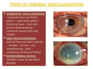 Aborizing Pattern TOPIC - CORNEA - Anatomy and Physiology of cornea BASICS | PPTX