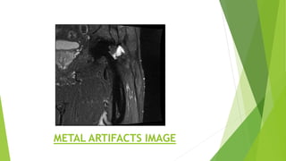 METAL ARTIFACTS IMAGE
 