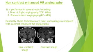 Non contrast enhanced MR angiography
It is performed in several ways including:
1.Time of flight angiography(TOF- MRA)
2. Phase contrast angiography(PC- MRA)
Generally, these techniques are time- consuming as compared
with contrast enhanced MR angiography.
Non- contrast Contrast image
image
 