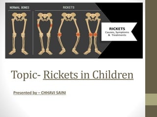 Topic- Rickets in children by Chhavi Saini | PPTX