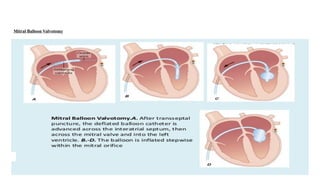 Valvotomy Instrument TOPIC OF PRESENTATION- VALVULAR HEART DISEASES.pptx