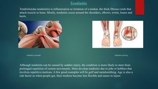 Tendinitis
Tendinitis(aka tendonitis) is inflammation or irritation of a tendon, the thick fibrous cords that
attach muscle to bone. Mostly, tendinitis occur around the shoulders, elbows, wrists, knees and
heels.
Tendinitis at shoulder Tendinitis at the leg
Although tendinitis can be caused by sudden injury, the condition is more likely to stem from
prolonged repetition of certain movements. Most develop tendinitis due to jobs or hobbies that
involves repetitive motions. A few good examples will be golf and metalsmithing. Age is also a
risk factor as when people get, their tendons become less flexible and easier to injure.
 