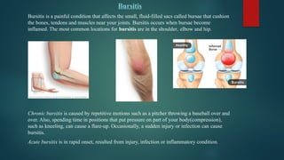 Bursitis
Bursitis is a painful condition that affects the small, fluid-filled sacs called bursae that cushion
the bones, tendons and muscles near your joints. Bursitis occurs when bursae become
inflamed. The most common locations for bursitis are in the shoulder, elbow and hip.
Chronic bursitis is caused by repetitive motions such as a pitcher throwing a baseball over and
over. Also, spending time in positions that put pressure on part of your body(compression),
such as kneeling, can cause a flare-up. Occasionally, a sudden injury or infection can cause
bursitis.
Acute bursitis is in rapid onset, resulted from injury, infection or inflammatory condition.
 