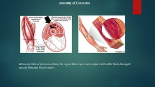 Anatomy of Contusion
When one falls or receives a blow, the region that experiences impact will suffer from damaged
muscle fibre and blood vessels.
 
