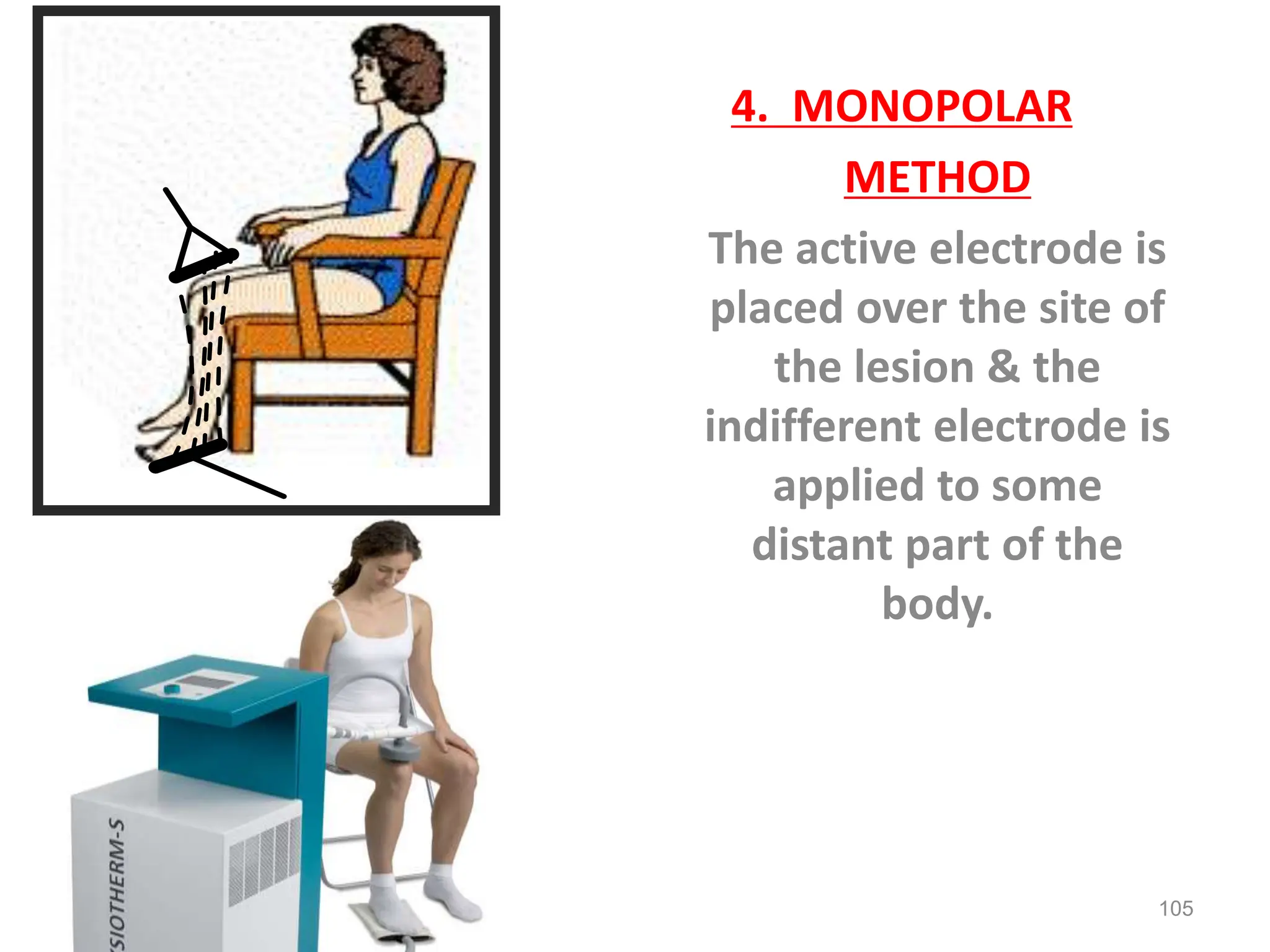 4. MONOPOLAR
METHOD
The active electrode is
placed over the site of
the lesion & the
indifferent electrode is
applied to some
distant part of the
body.
105
 